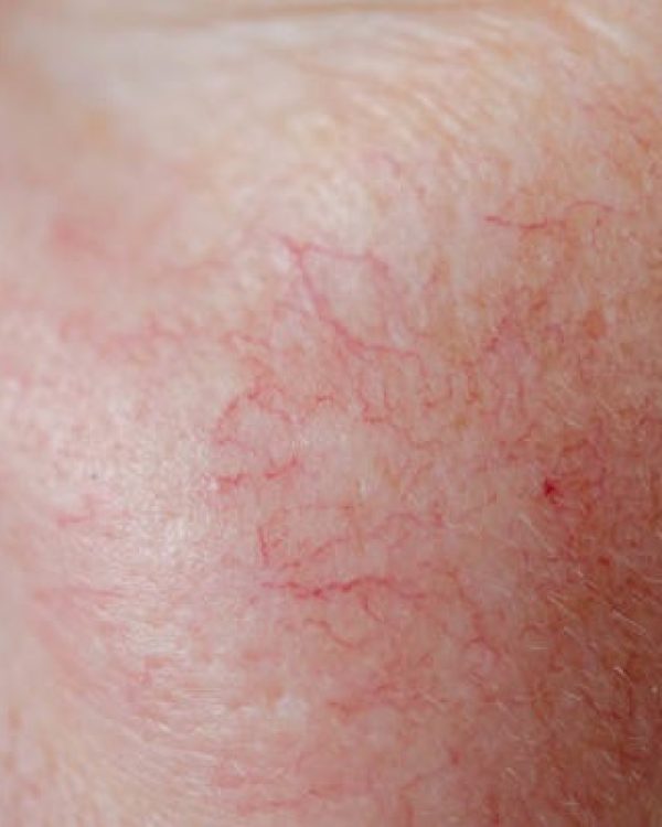 Close up of human face skin with vascular problems, couperose on sensitive skin